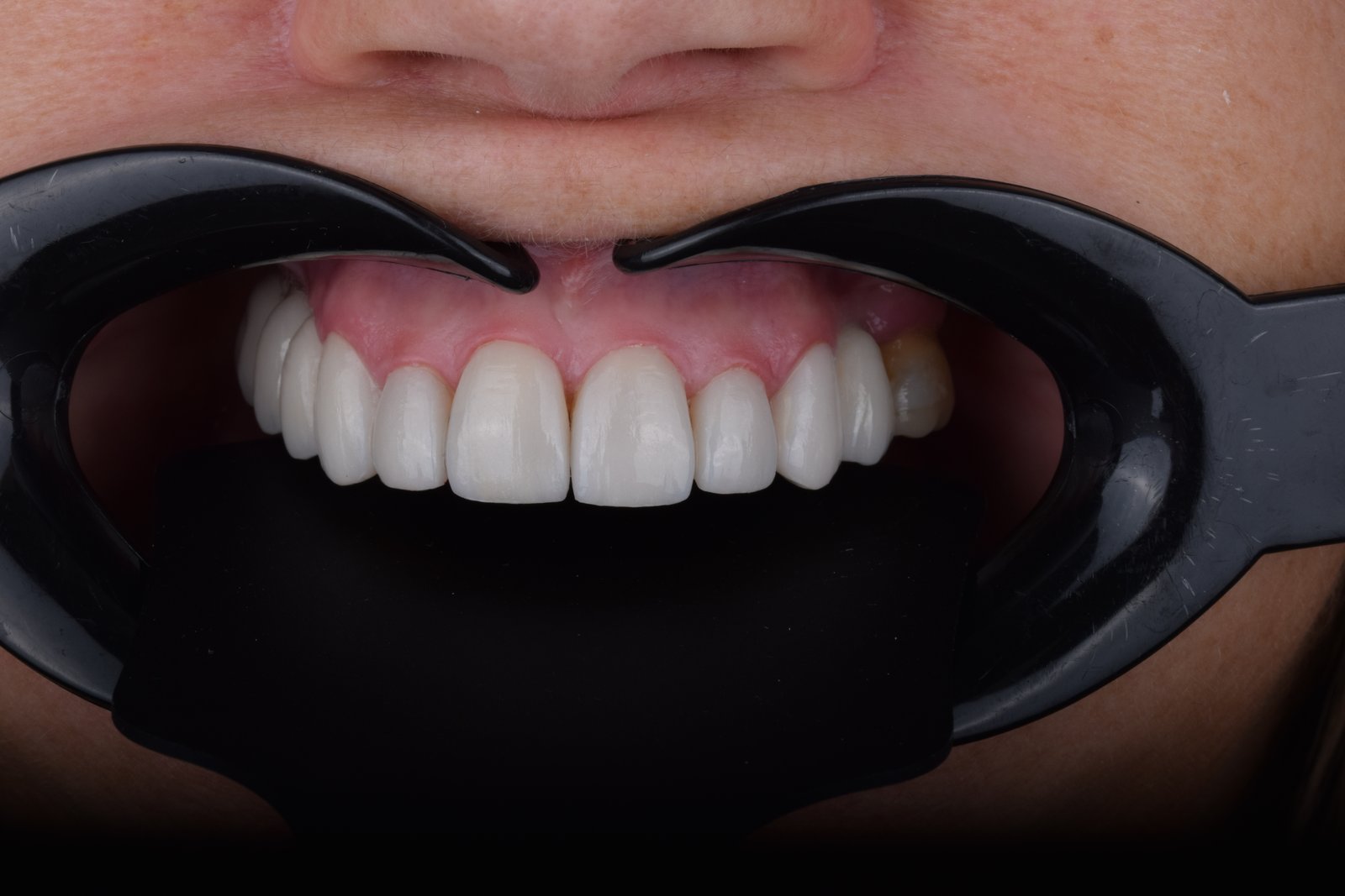 Diseño de sonrisa con carillas en DDS Odontología